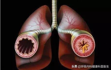 肺气肿一般寿命多少年图片