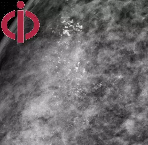 包括弥漫或散在分布,区域状分布,簇状分布,线样分布,节段样分布等五种