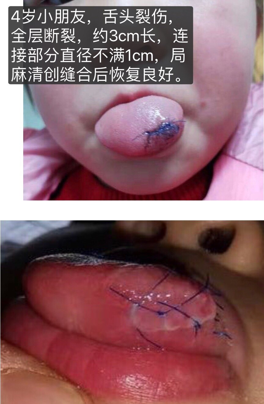 关于儿童局麻缝合的一些感想 - 好大夫在线