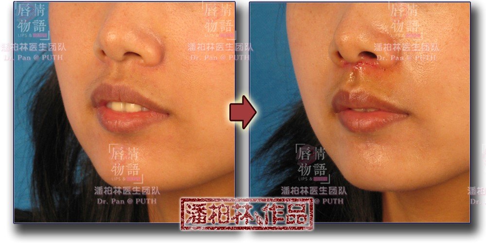 参考费用:￥12,000元手术时间:约1小时适合人群:上唇人中过短,红唇