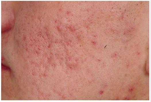 目前已经提出了几种关于萎缩型及肥大型的痤疮瘢痕的分类体系.