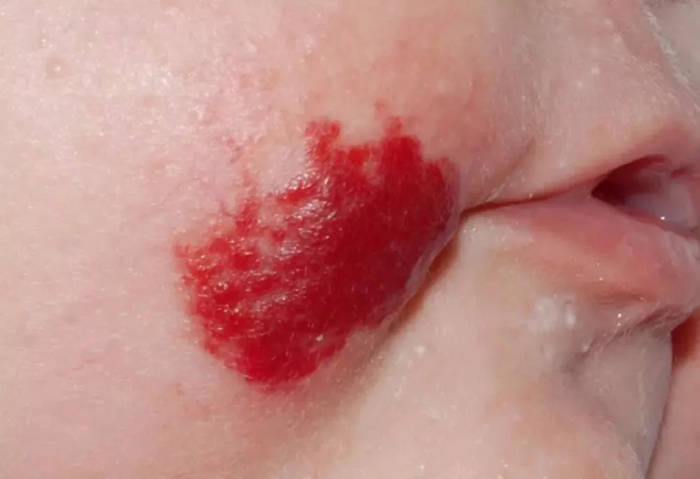 新生儿脸上红斑如何治疗?3种血管性胎记的横向对比 