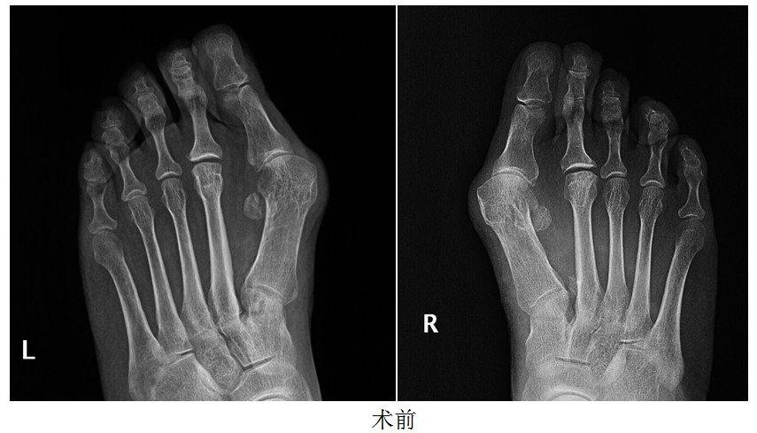 双足拇外翻的手术治疗
