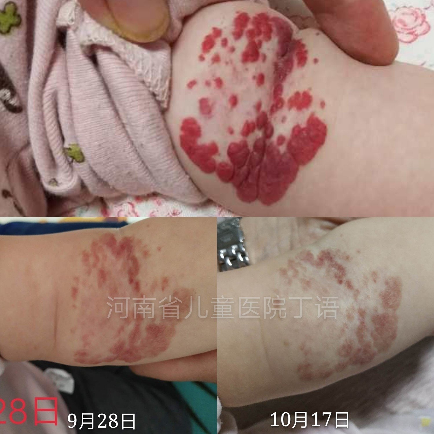 宝宝得了血管瘤,该怎么治疗_血管瘤