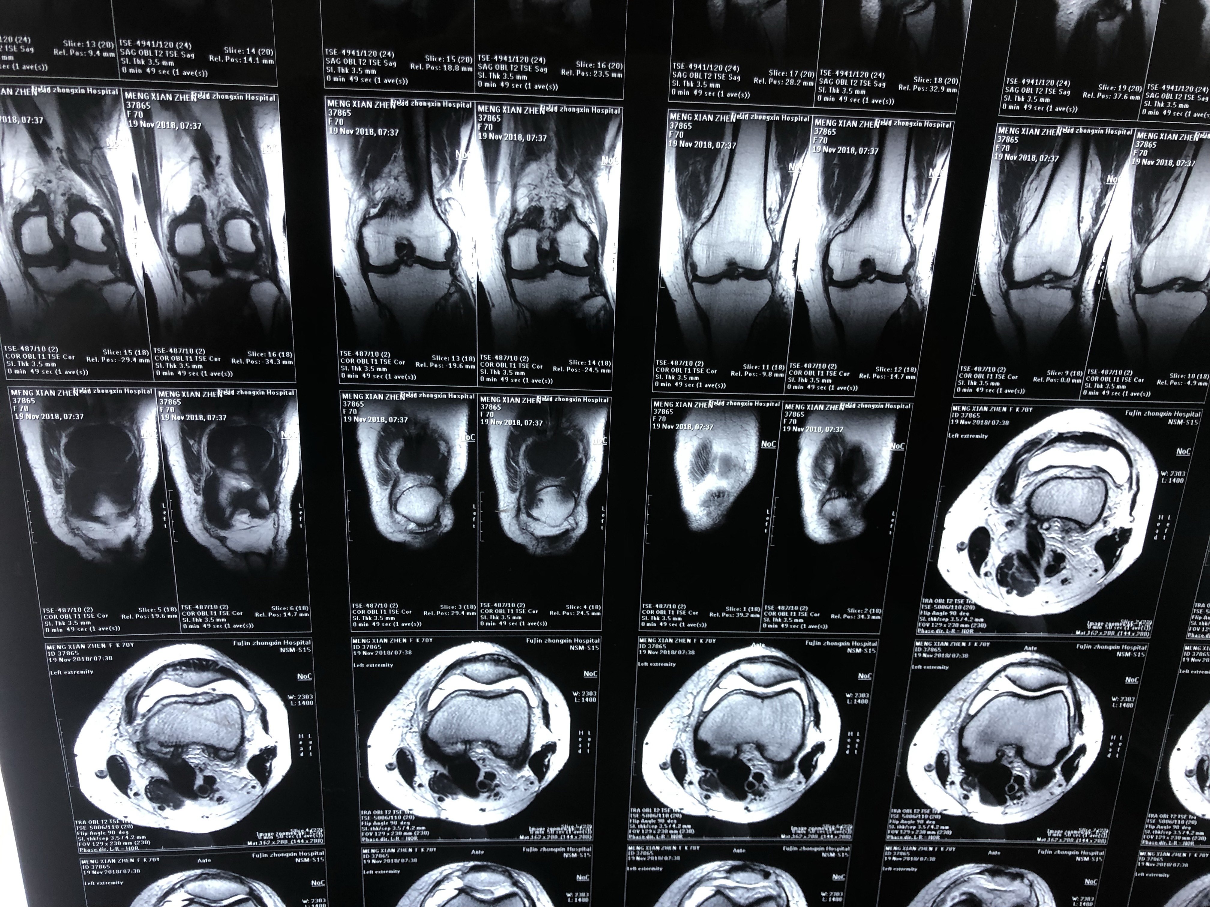 術前mri-膝關節關節鏡下損傷半月板關節鏡下切除修整損傷半月板修整後