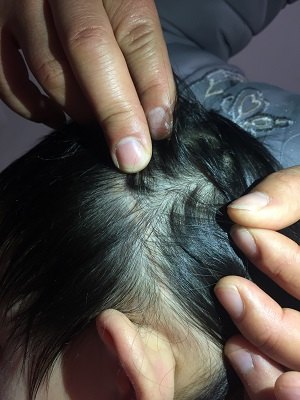 颅缝早闭——治疗篇_狭颅症_狭颅症治疗方式 - 好大夫在线