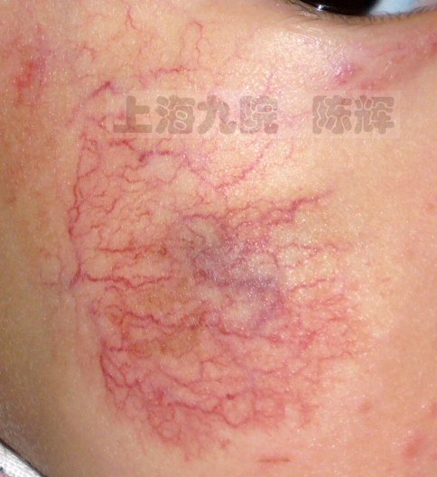走进"婴幼儿血管瘤"的世界——高清大图下的细节辨识和诊疗精要_皮肤