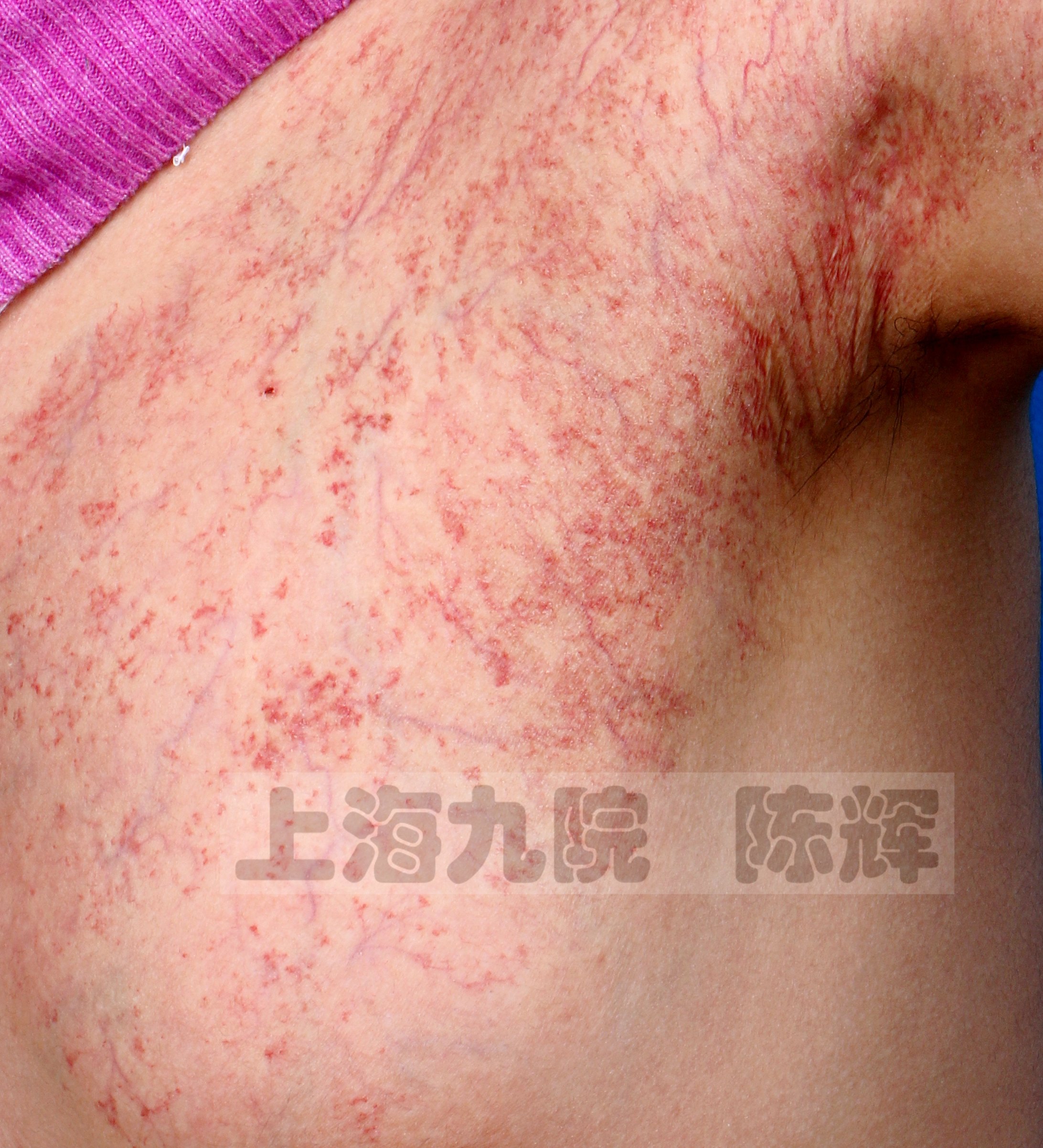 世界——高清大图下的细节辨识和诊疗精要_皮肤血管瘤_疾病介绍_介绍