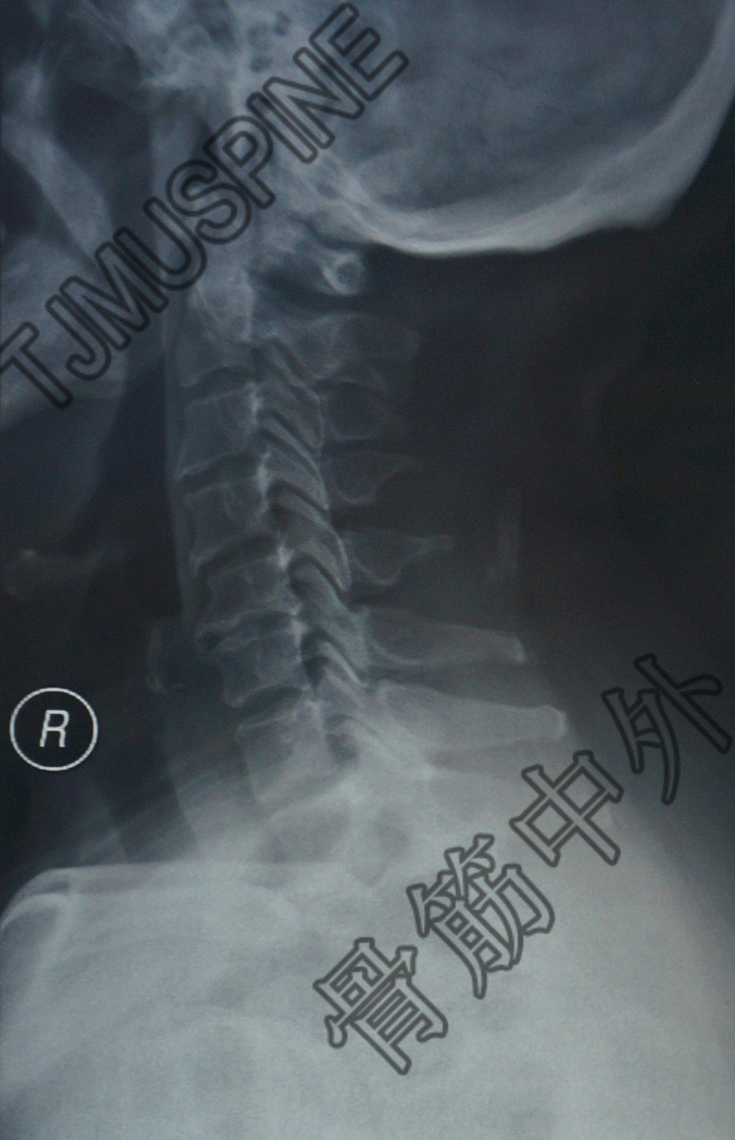 頸椎後路單開門減壓術 - 好大夫在線