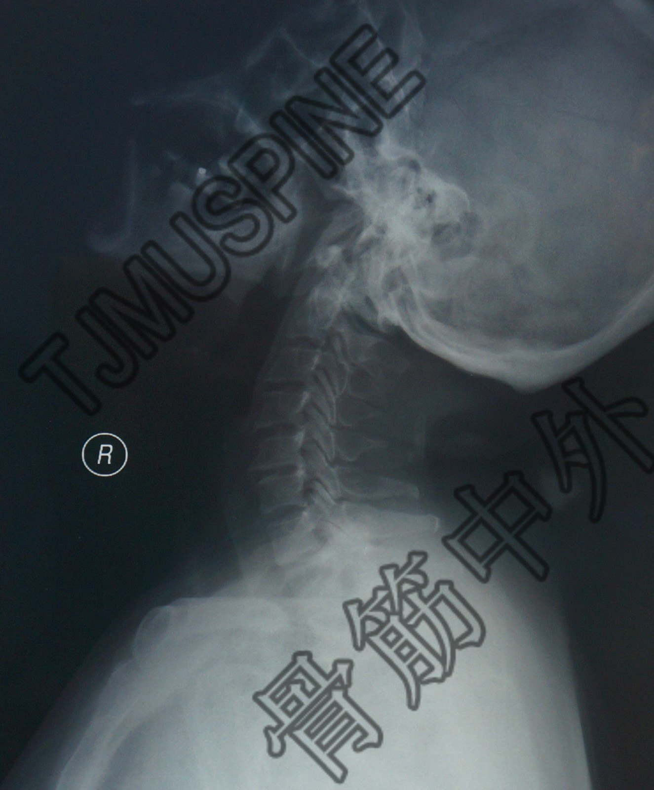 頸椎後路單開門減壓術