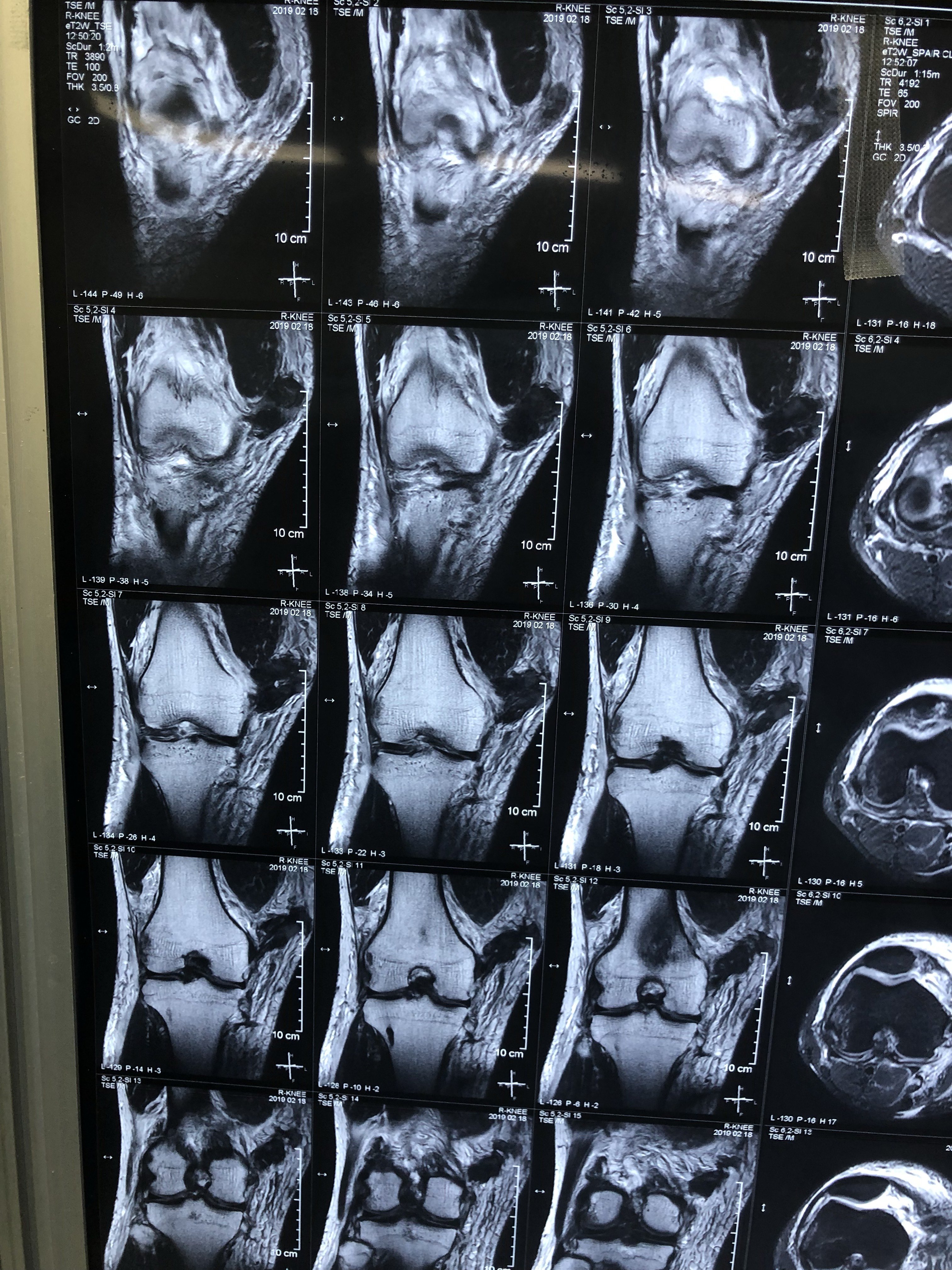 滑雪至双膝膝关节韧带损伤,关节镜下行双侧韧带重建 - 好大夫在线