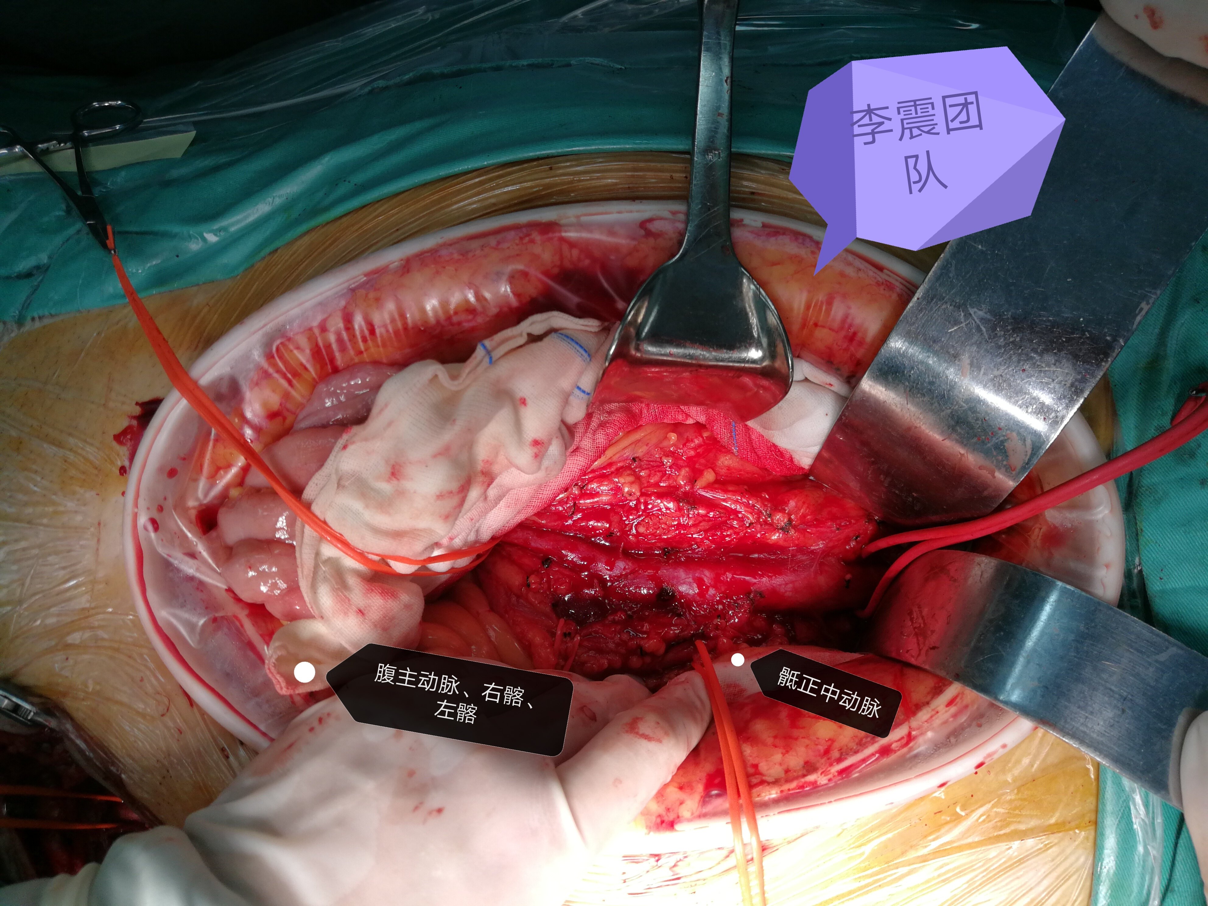 脑瘤 伽马刀 活几年_先天性脑瘤手术后能活多久_骨折手术拆线后多久能洗澡