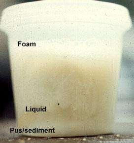 支气管扩张吐痰一天一杯子放着还会分层每天做一事可防