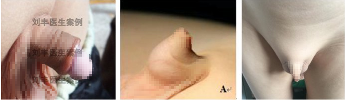 隐匿性阴茎的诊断及治疗 男性生殖器畸形 男性生殖器畸形 隐匿性阴茎的诊断及治疗 男性生殖器畸形 男性生殖器畸形
