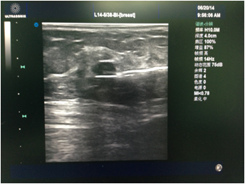 1552446908713889.png 乳腺微创手术切除乳腺结节