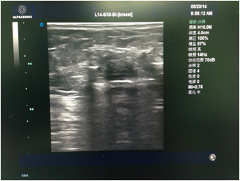 乳腺微创手术切除乳腺结节