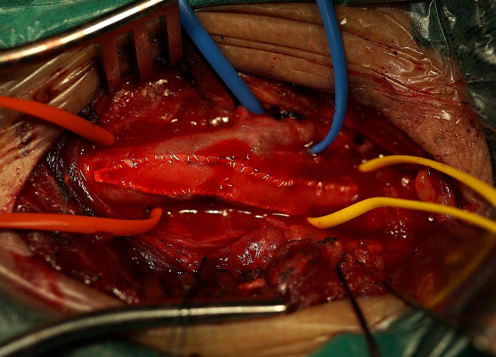 颈动脉内膜剥脱术一例 
