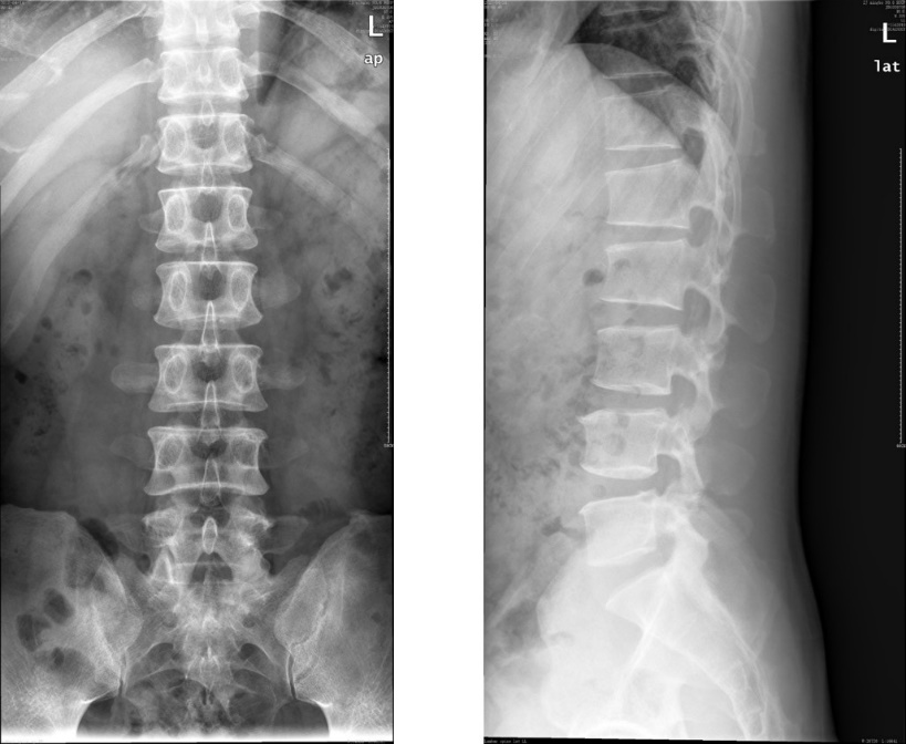 腰椎CTスキャンのリスク