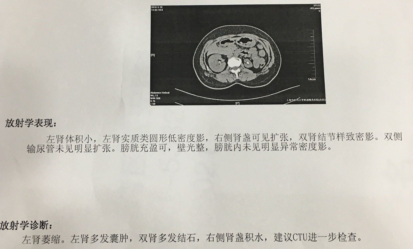 双肾结石.jpg