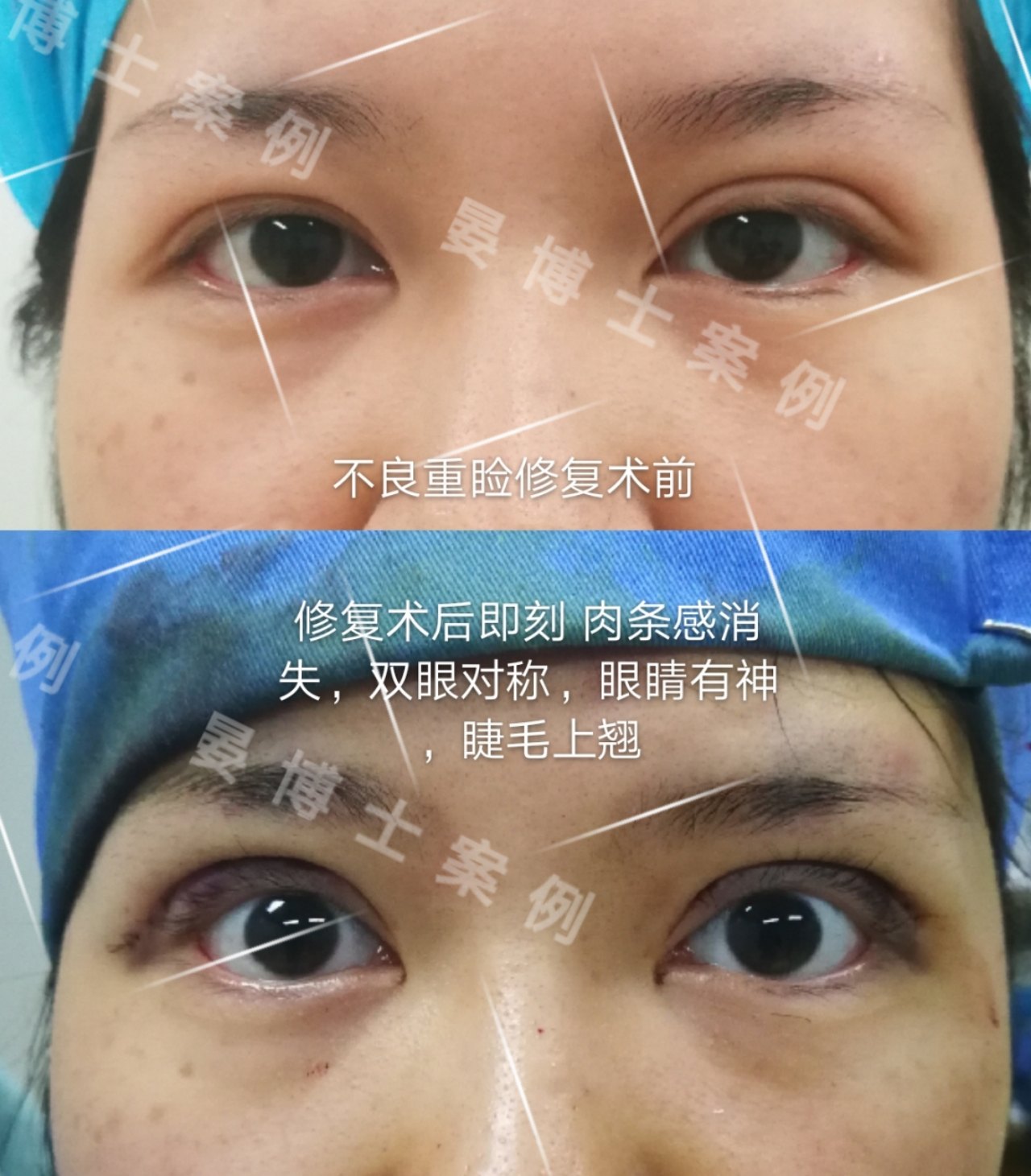 双眼皮的修复_哪里有专业修复双眼皮的医院_双眼皮修复价格