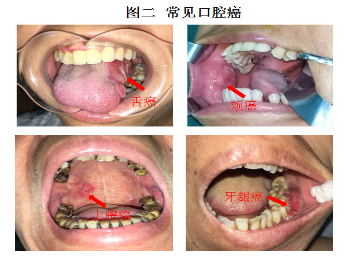 口腔溃疡癌变图片