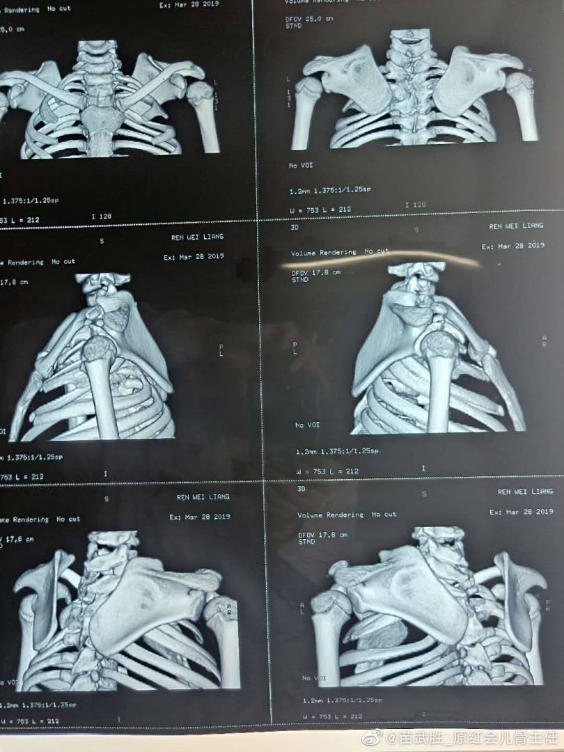 近期做的先天性高肩胛术前术后照片