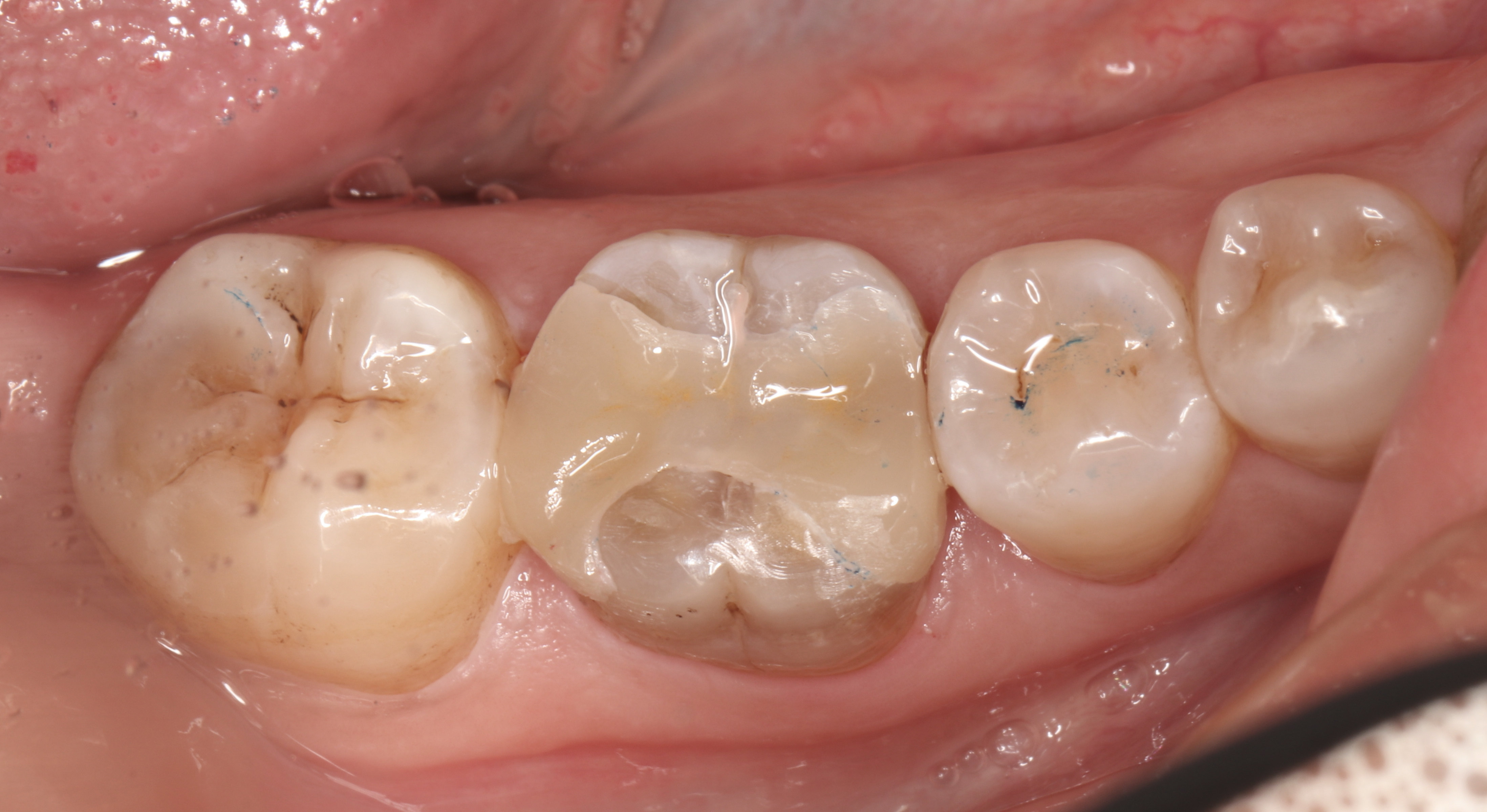 后牙嵌体修复一例 