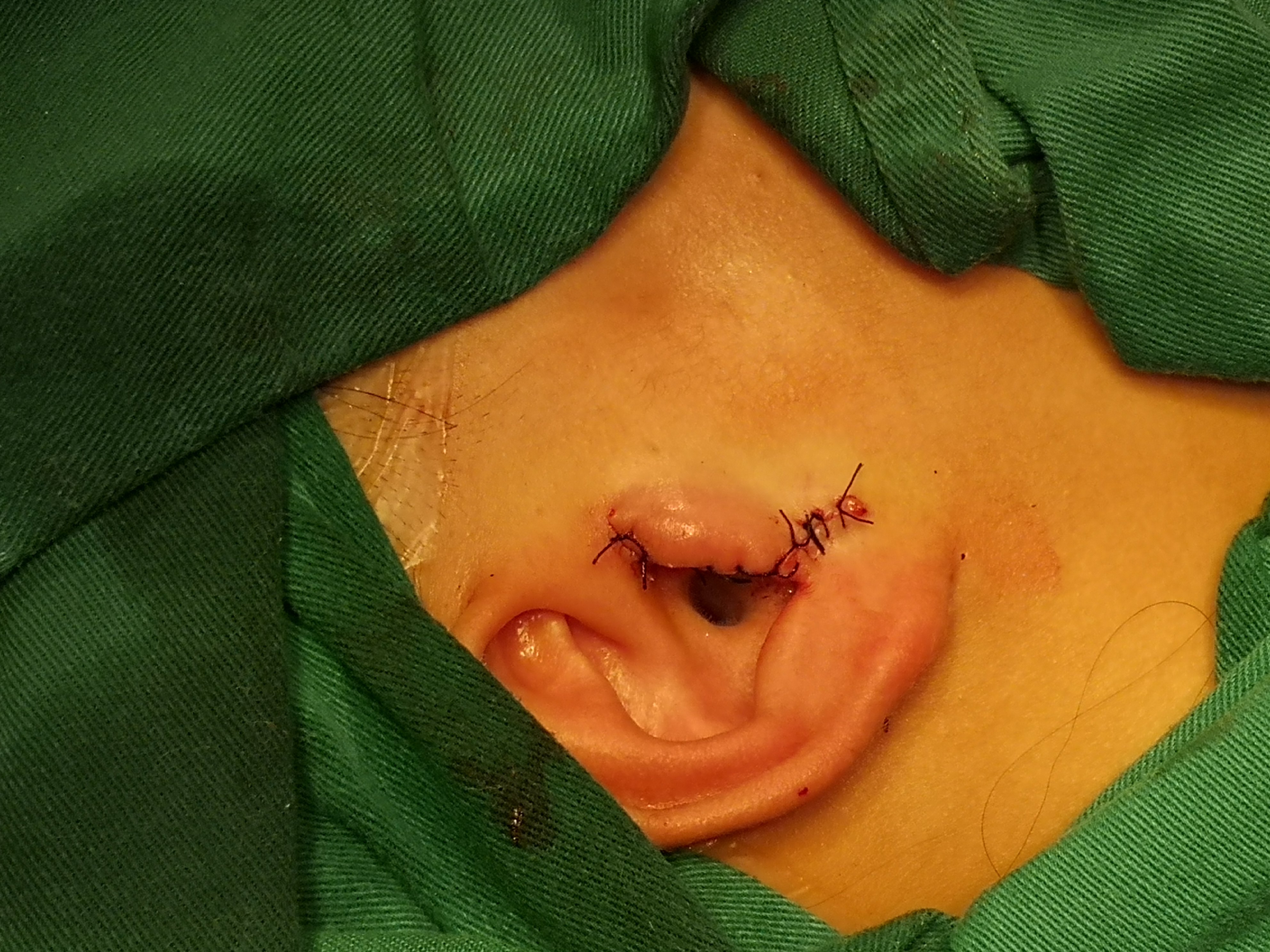 十二岁小姑娘副耳也可局麻下做得这么漂亮