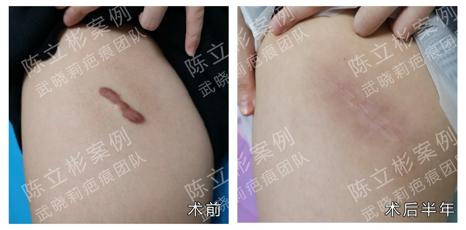 大腿疤痕疙瘩术后半年复诊记录 - 好大夫在线