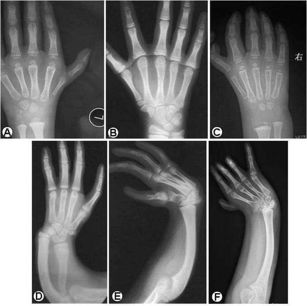 儿童手部骨骼发育图图片