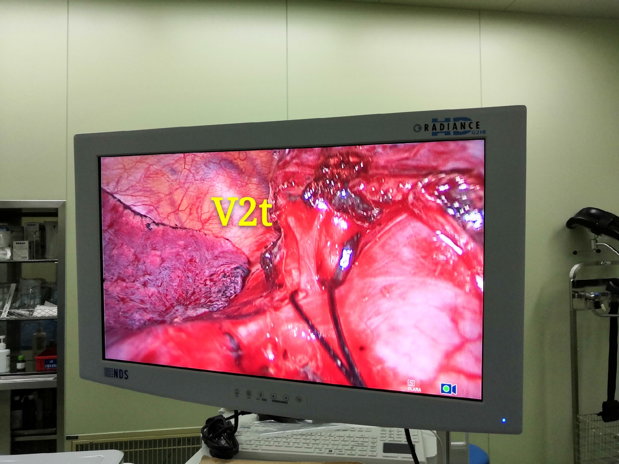 哈医大二院胸外科经典病例之胸腔镜下右肺s2切除术 - 好大夫在线