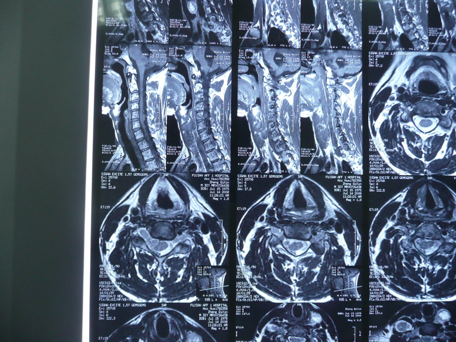 贺晓生教授多发神经纤维瘤病案例 - 好大夫在线