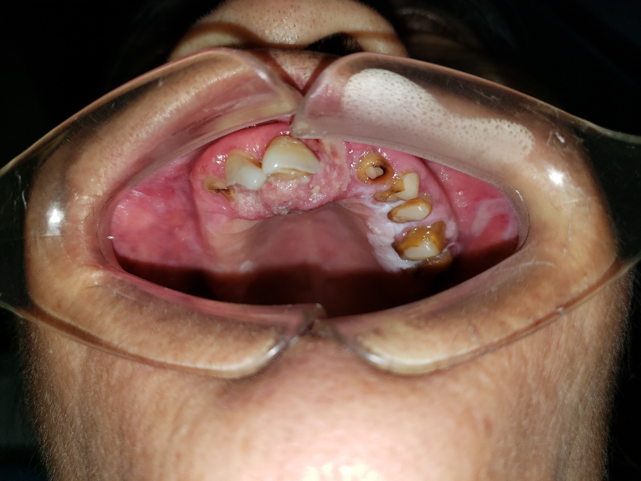 手术切除颈部淋巴结后发现是鳞癌转移,再追踪原发灶才发现口内的牙龈