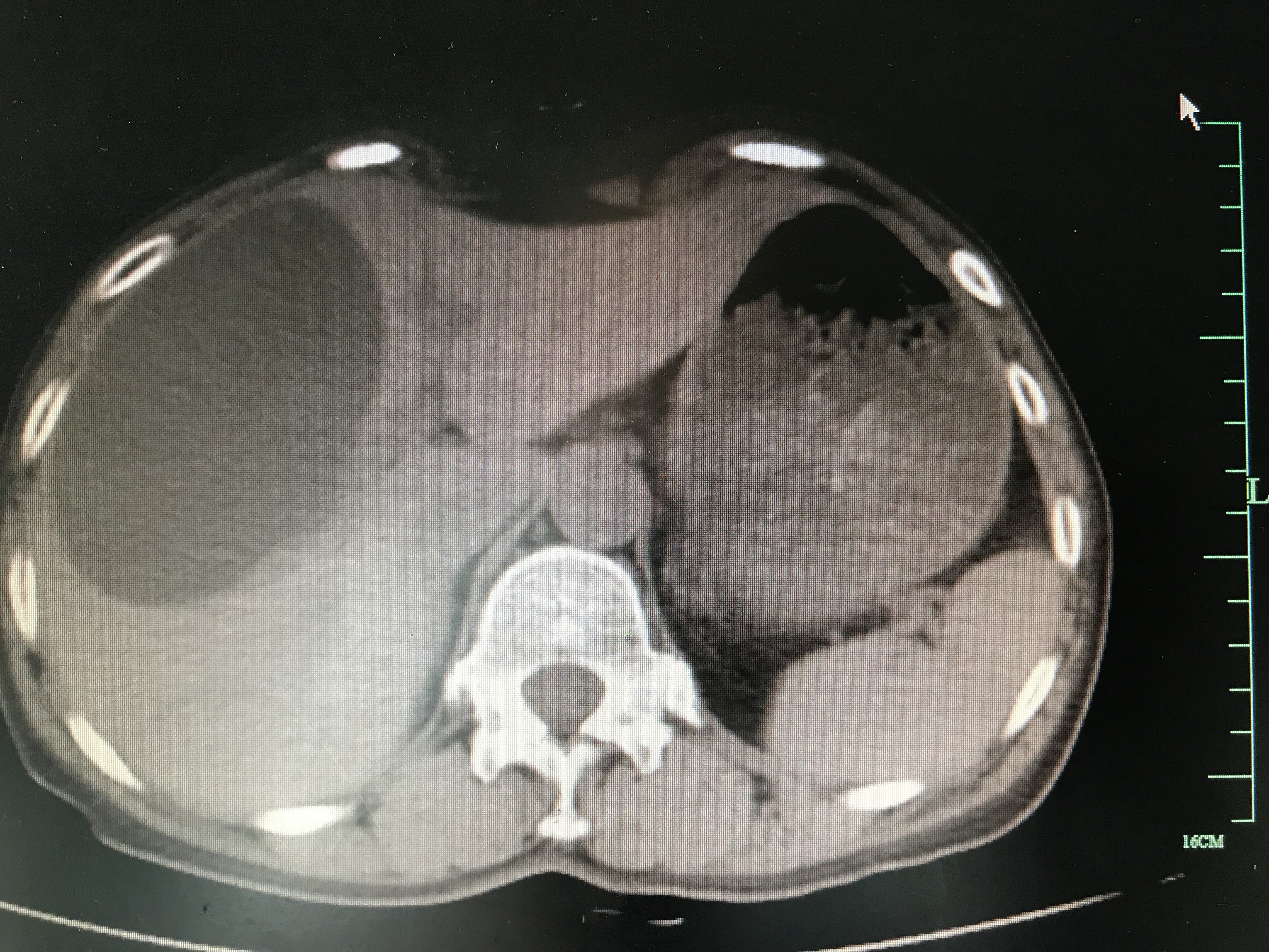 肝囊肿ct影像表现图片图片