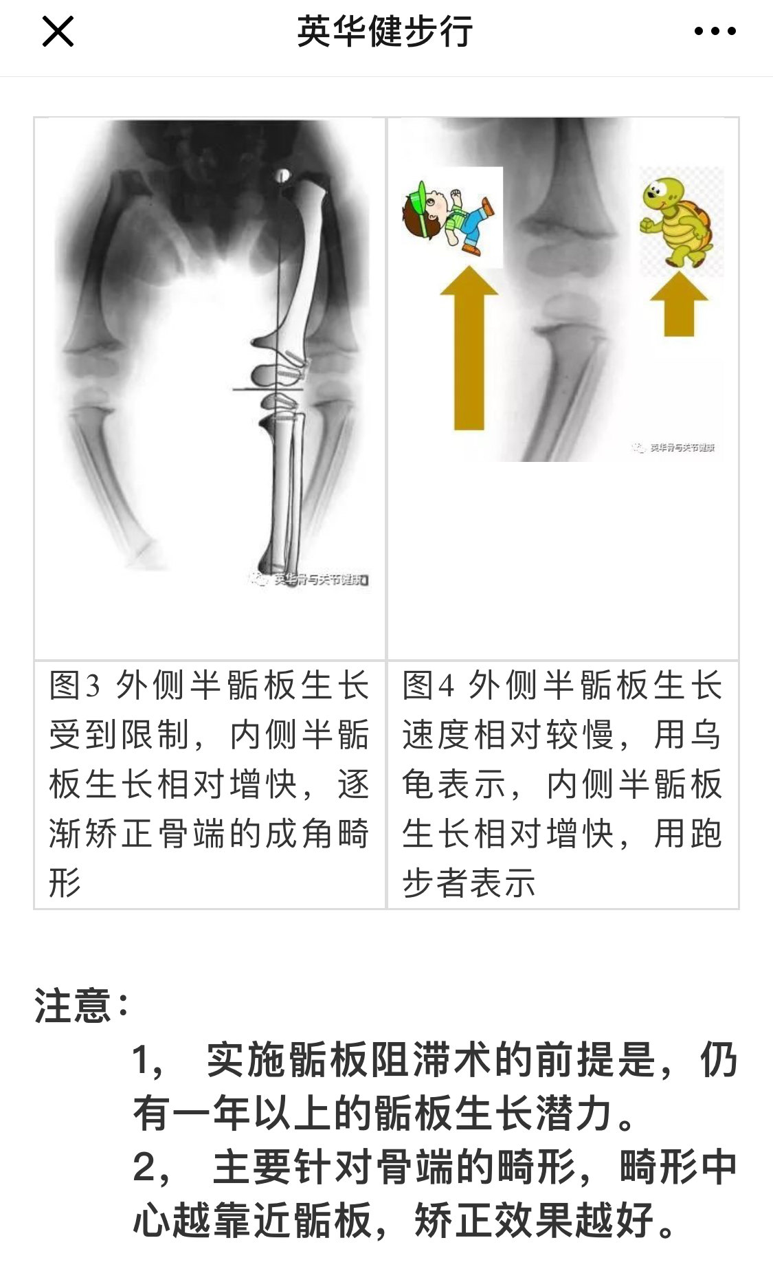 骺板以上图片