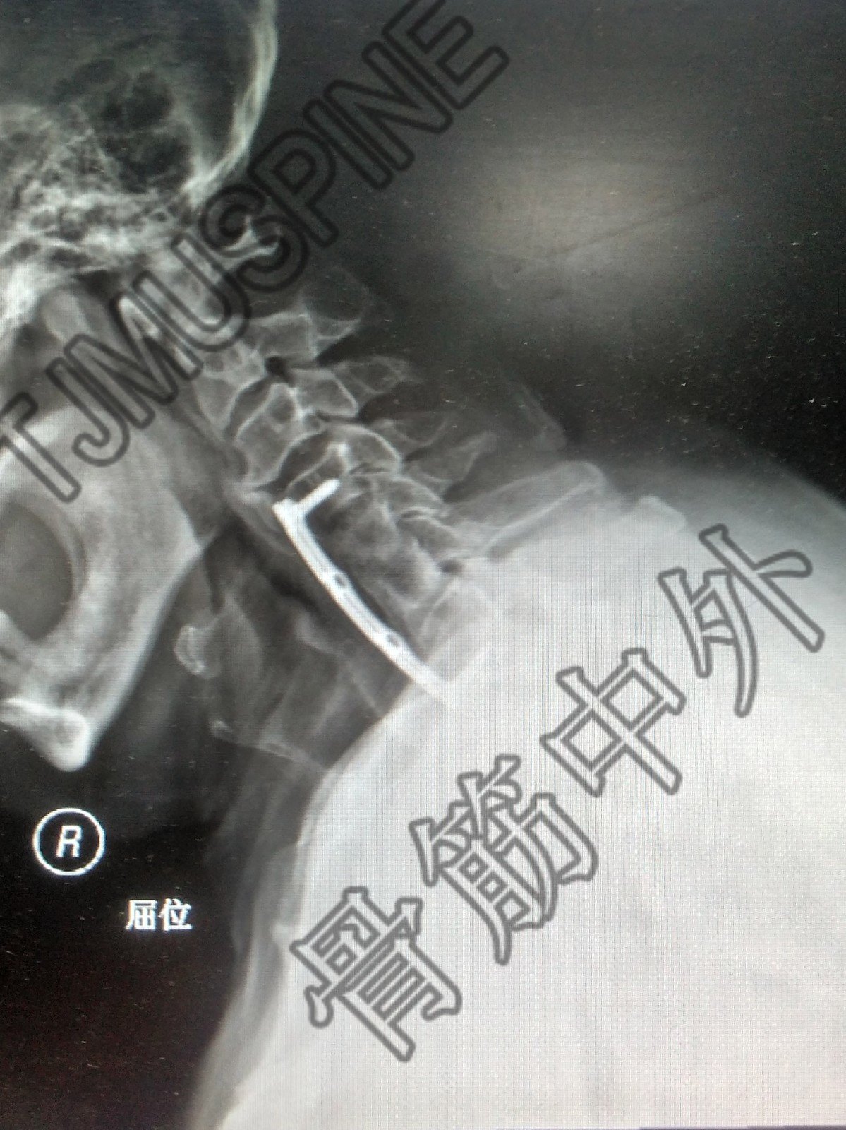 頸椎結核術後脊髓型頸椎病