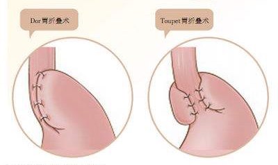 180度和270度折叠360度胃底折叠(转载自梅奥医学教育研究基金会)手术