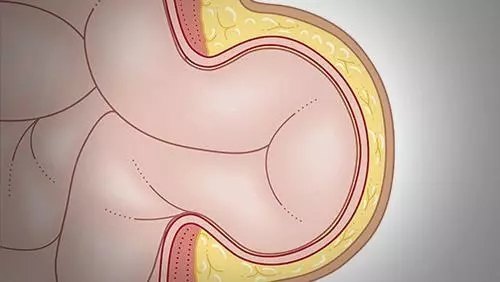 一個五毫米的孔就能解決小兒腹股溝疝