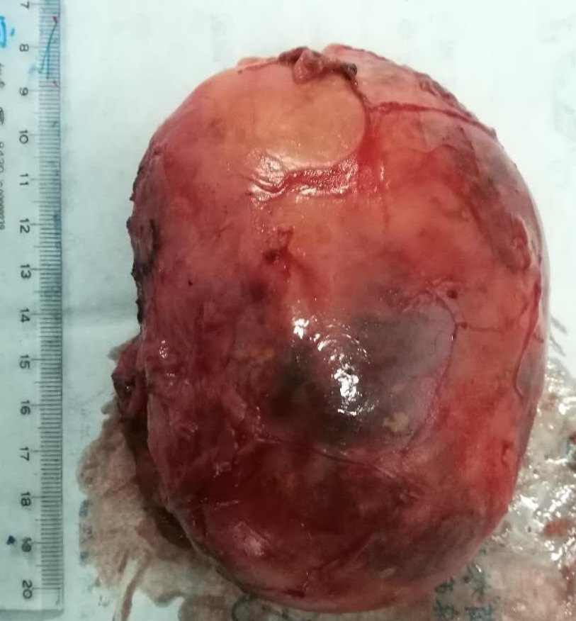 肾上腺肿瘤_手术_治疗方式 - 好大夫在线