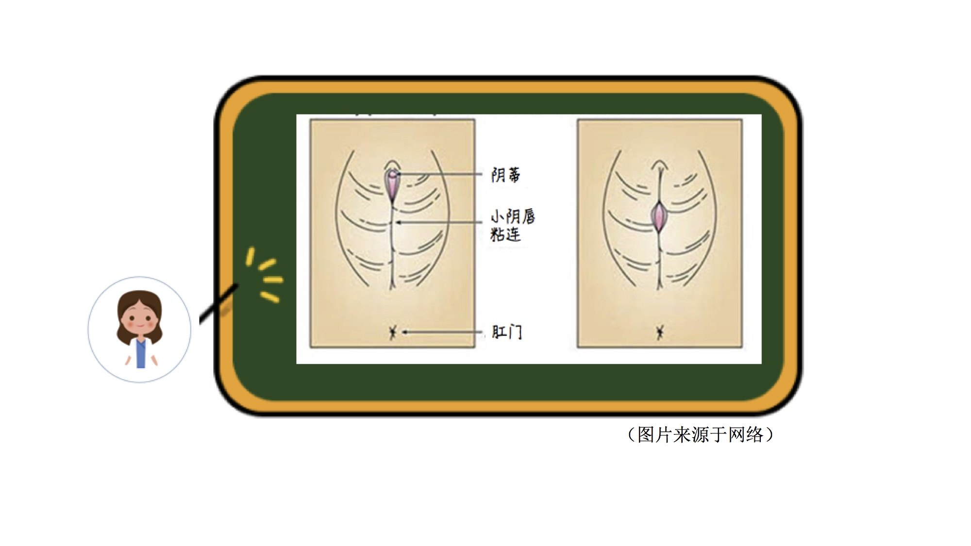 家有女寶——小陰唇粘連怎麼辦? - 好大夫在線