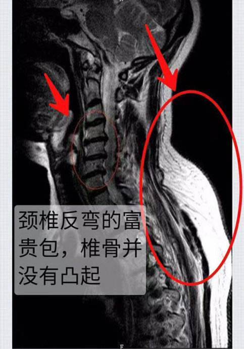 如果症状严重,有痛感或肢体麻木,建议在骨科进行检查,确认颈椎是否