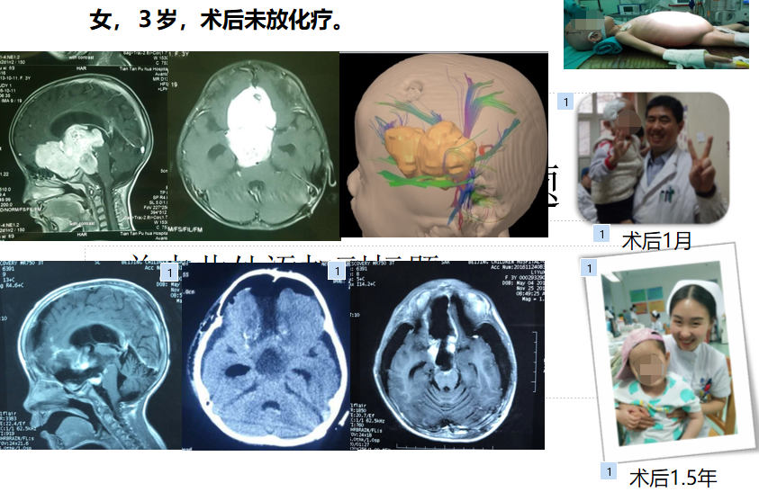 8)2017年北京卫视《生命缘》全程记录我院一例三岁视路胶质瘤患儿的