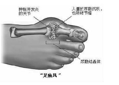 (4)「痛风性关节炎」是尿酸盐结晶沉积在关节及周围软组织中引起的
