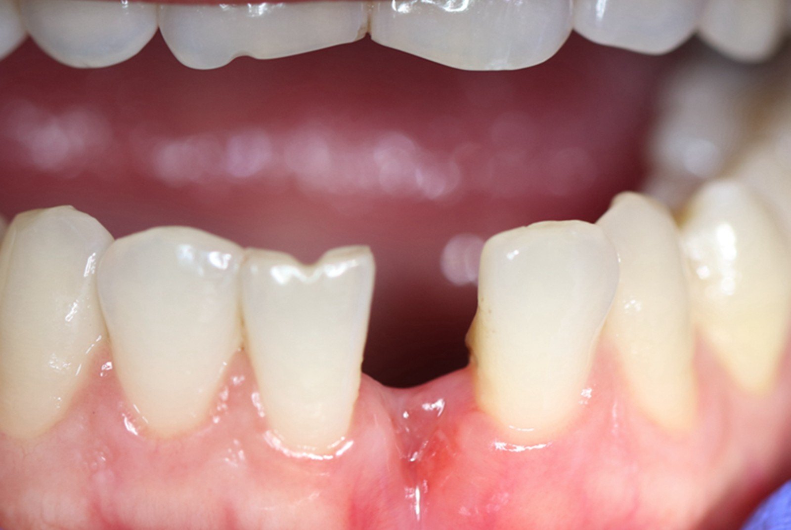 下牙缺失 - 好大夫在线