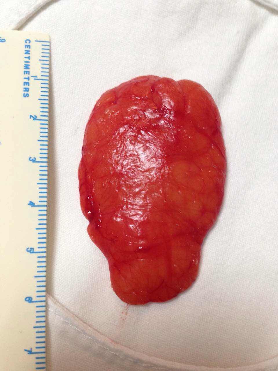 丰胸手术过程做多久_丰胸部手术_丰胸怎么做的手术过程