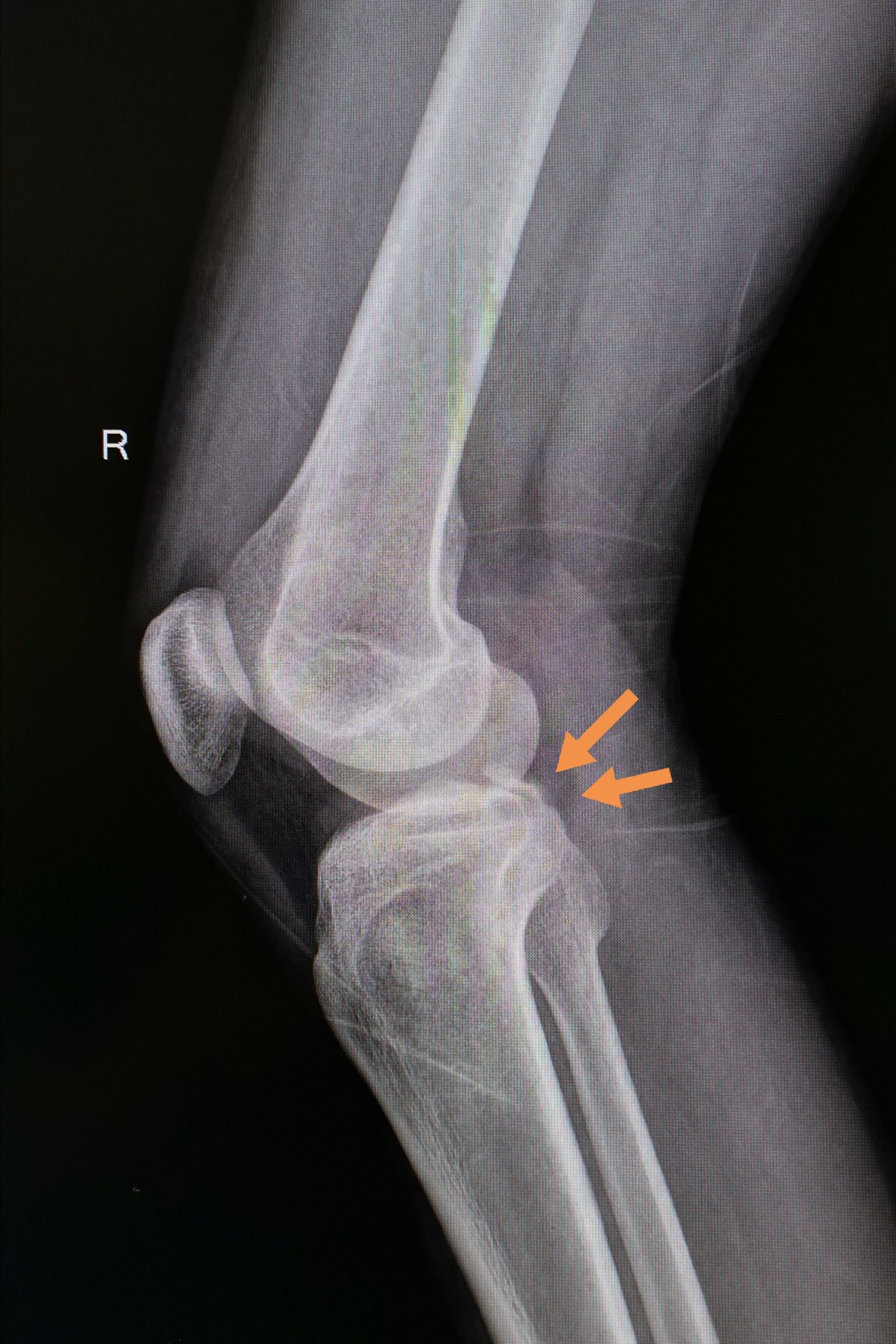 杨氏膝夹端提法治疗肩关节脱位并大结节撕脱骨折（有视频） - 骨科 -丁香园论坛