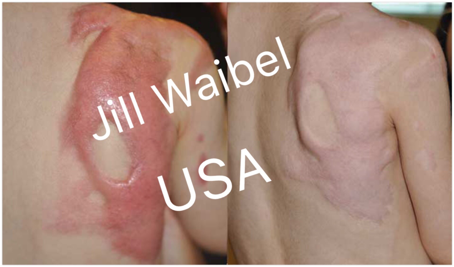 但在医学上,疤痕部位,持续时间与疗效尚无一致性结论.