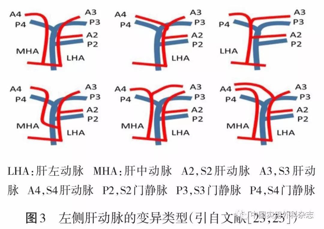 肝门部胆管癌的肝门区解剖学2019年1月