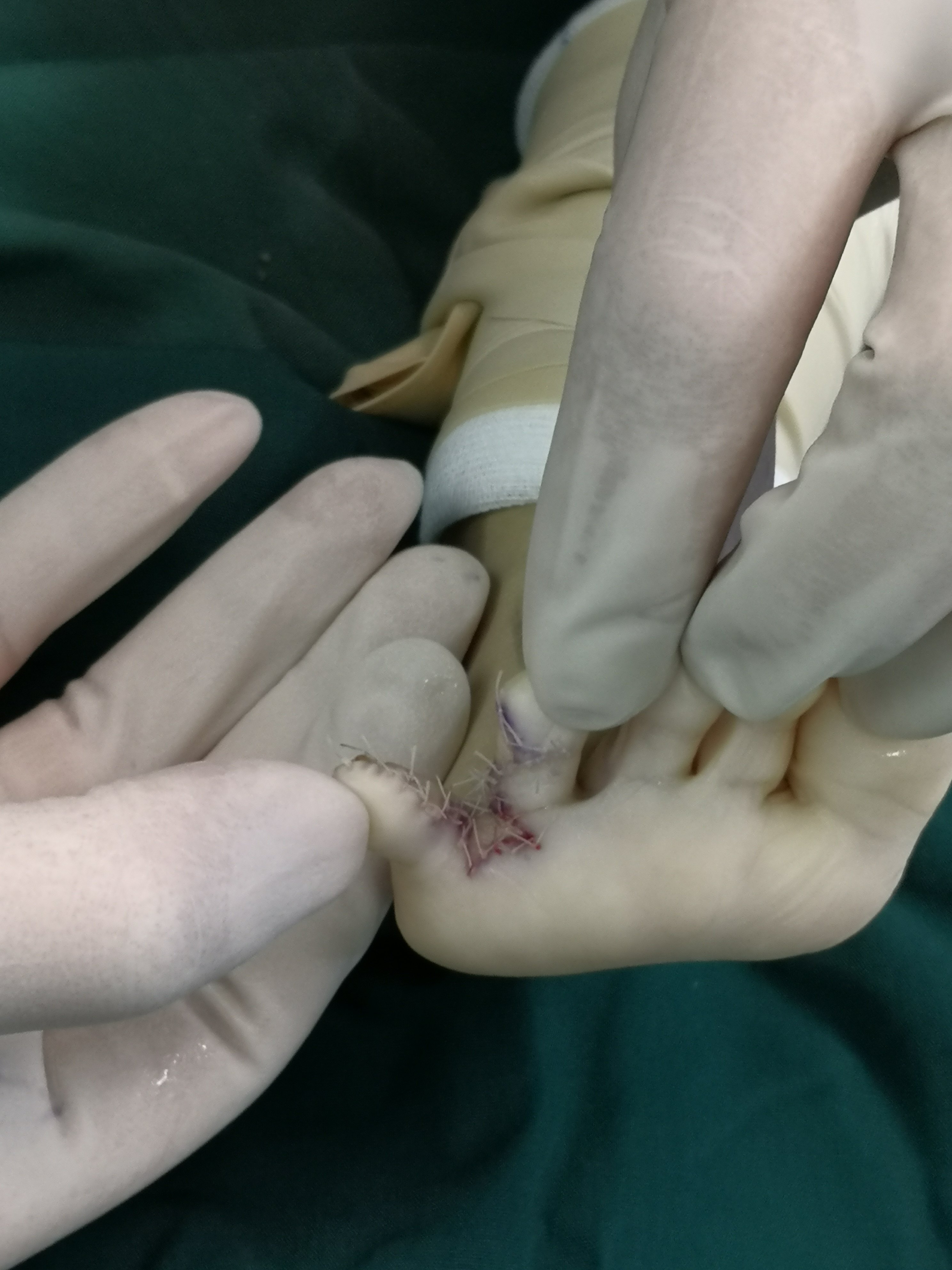 足45趾并趾多趾畸形怎么做哪些注意事项