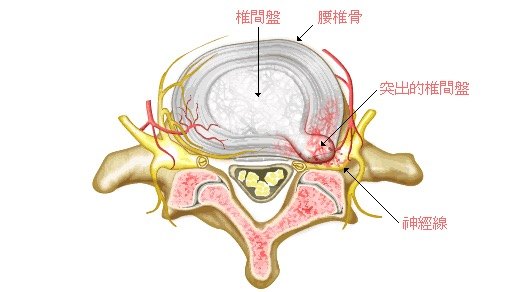 腰椎间盘突出症 与 腰肌劳损 的区别 腰椎间盘突出 腰椎间盘突出疾病介绍